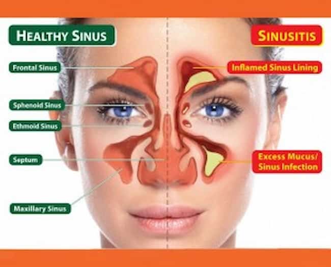 Sinusitis acute Sinusitis